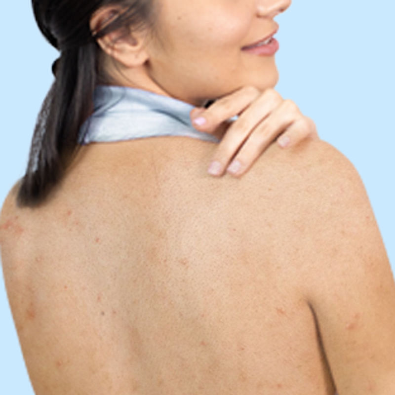 Body acne Concern Image