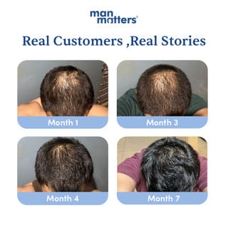 Man Matters Stage 4 Hair Regrowth Kit