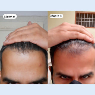 Man Matters Stage 2 Hair Regrowth Kit