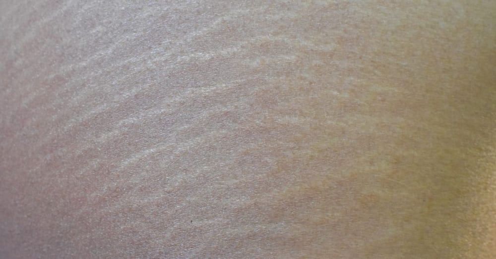 Stretch Marks on Breasts: Causes, Treatment, Prevention, More