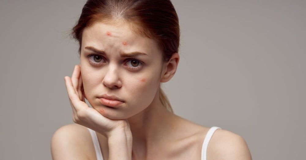 Acne-Prone Skin: What is it, Causes, How To Take Care of It!