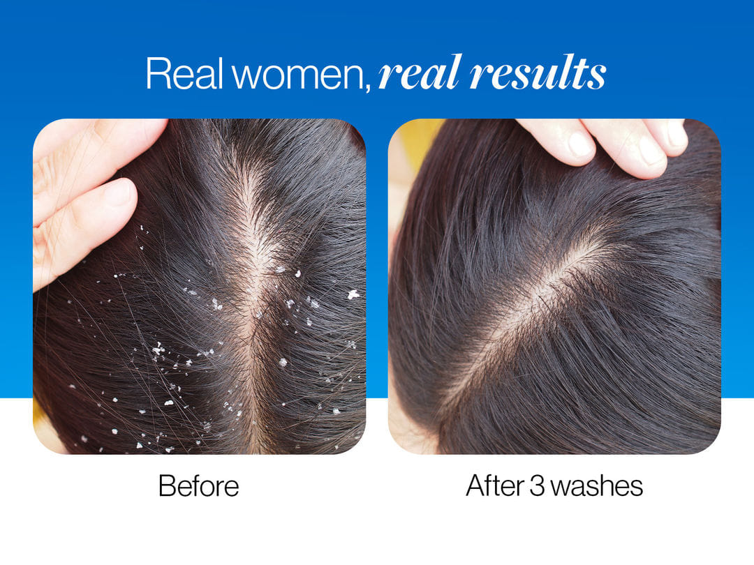 dandruff removal after 3 washes