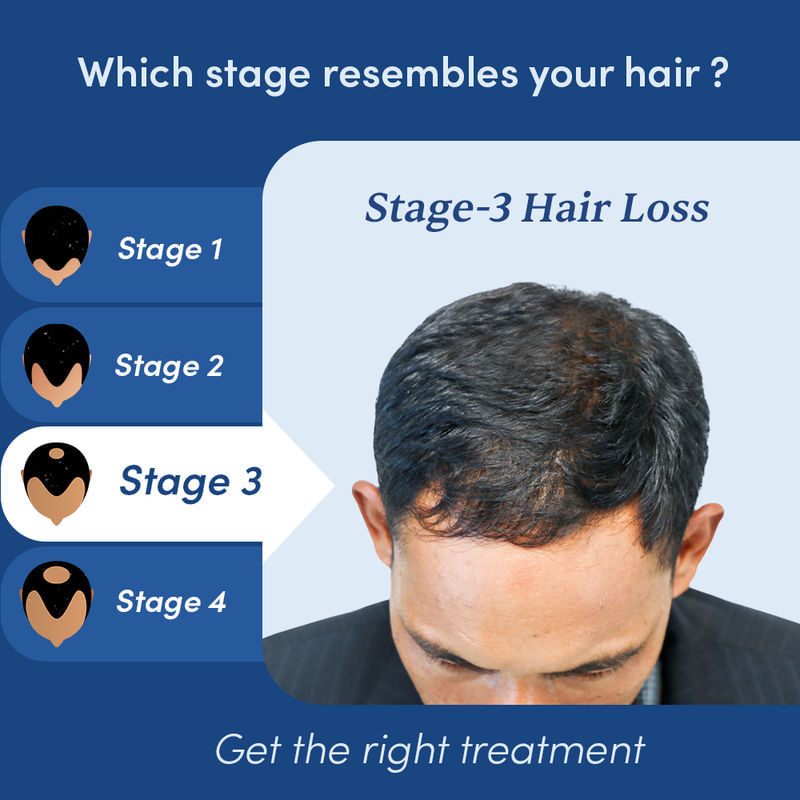 Minoxifin: Minoxidil 5 with Finasteride | Hair Loss & Growth Solution