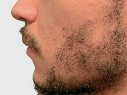 Patchy Beard Solution