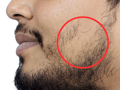 Patchy Beard Solution