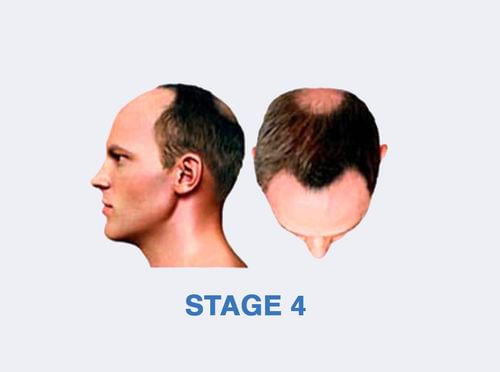 Stage 4 Hair Regrowth Solution