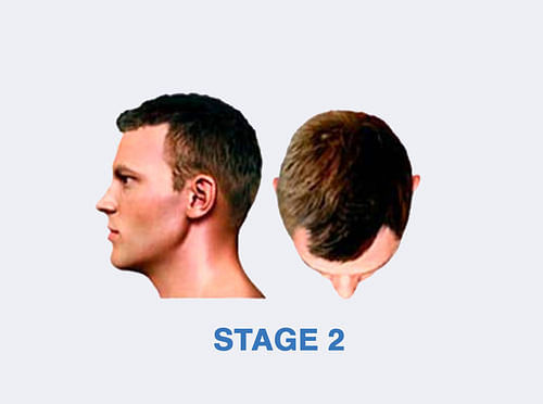 Stage 2 Hair Fall Solution