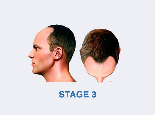 Stage 3 Hair Fall Solution