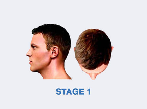 Stage 1 Hairfall Solution