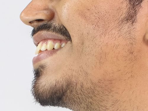 Low Beard Solution