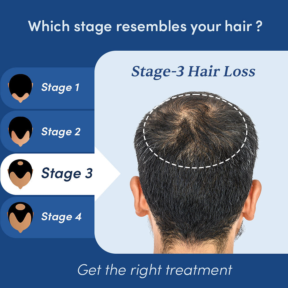 Zinc For Hair Loss  Why This Mineral Matters See Photos