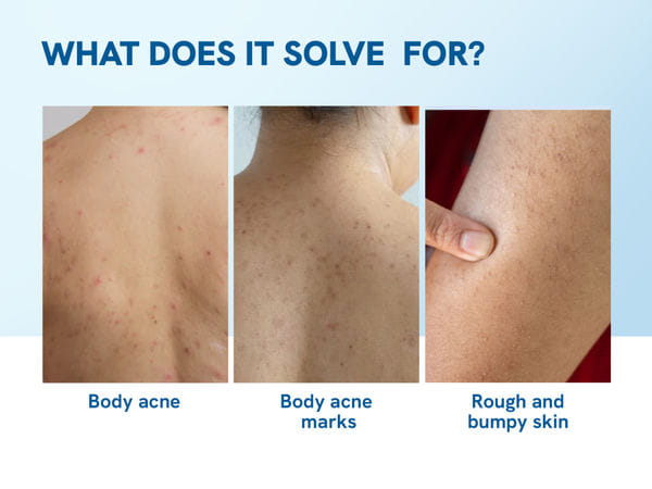 Body Acne Pack | 250 ml Body Wash & 200ml 10% Niacinamide Body Lotion ...