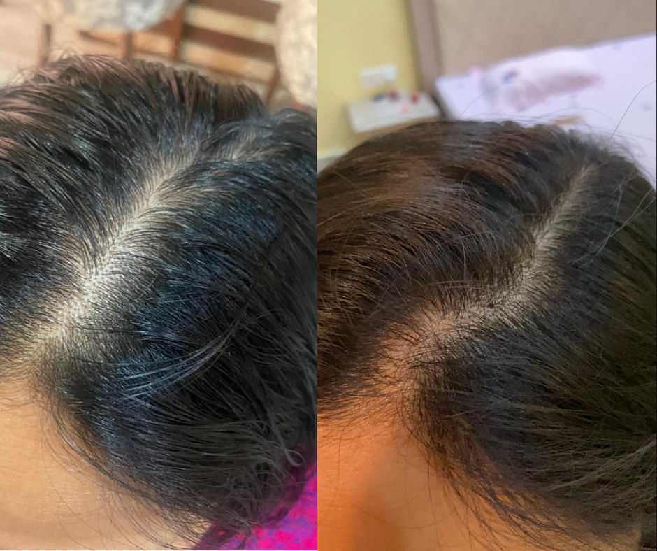 Live Life By Nature  My postpartum hair loss journey Ive been  exclusively using MONAT products for almost 3 years now  However in  September 35 months after having my baby I