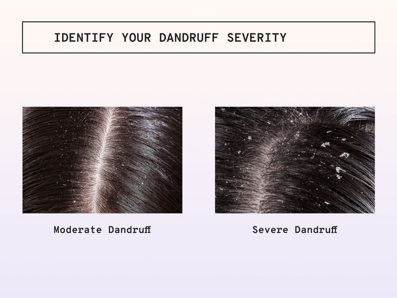 Buy Dandruff & Hairfall Kit For Women - Bodywise