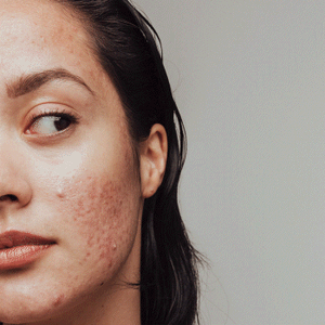Acne Safe