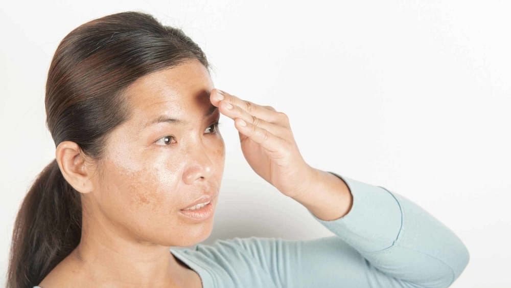How to Treat Dark Spots At Home