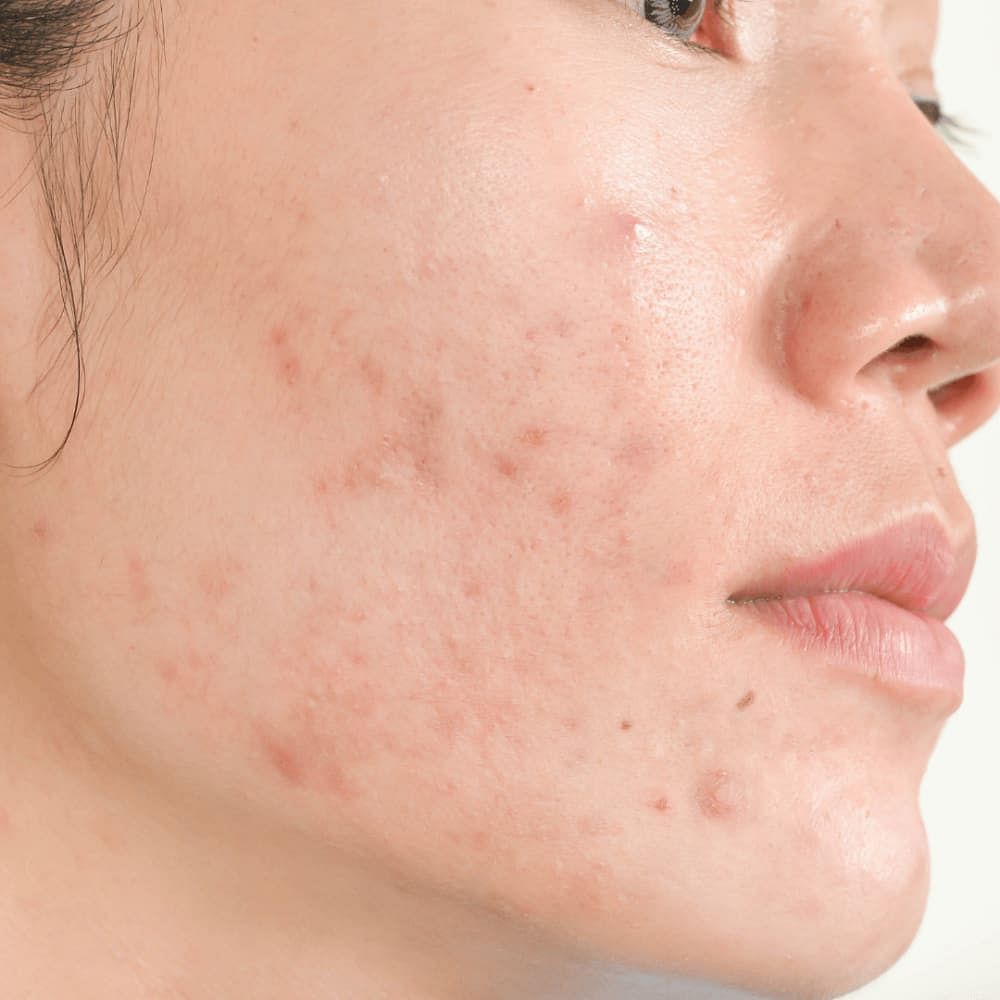 PCOS Acne & Pimple Causes, Treatment & More - Be Bodywise