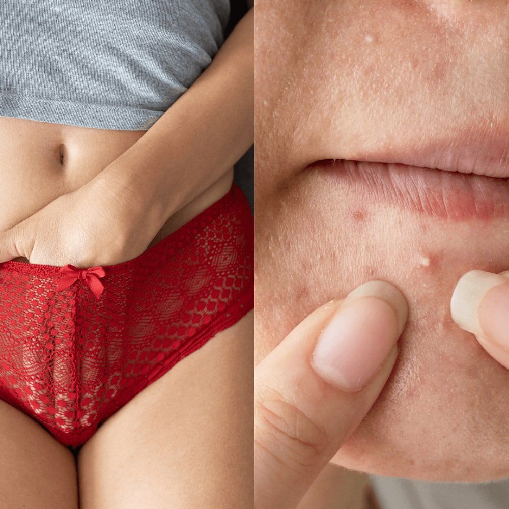 Does Female Masturbation Cause Pimples & Acne ~ Research-Backed