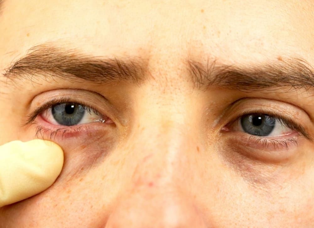 Bags Under Eyes in Men: How to Fight Back