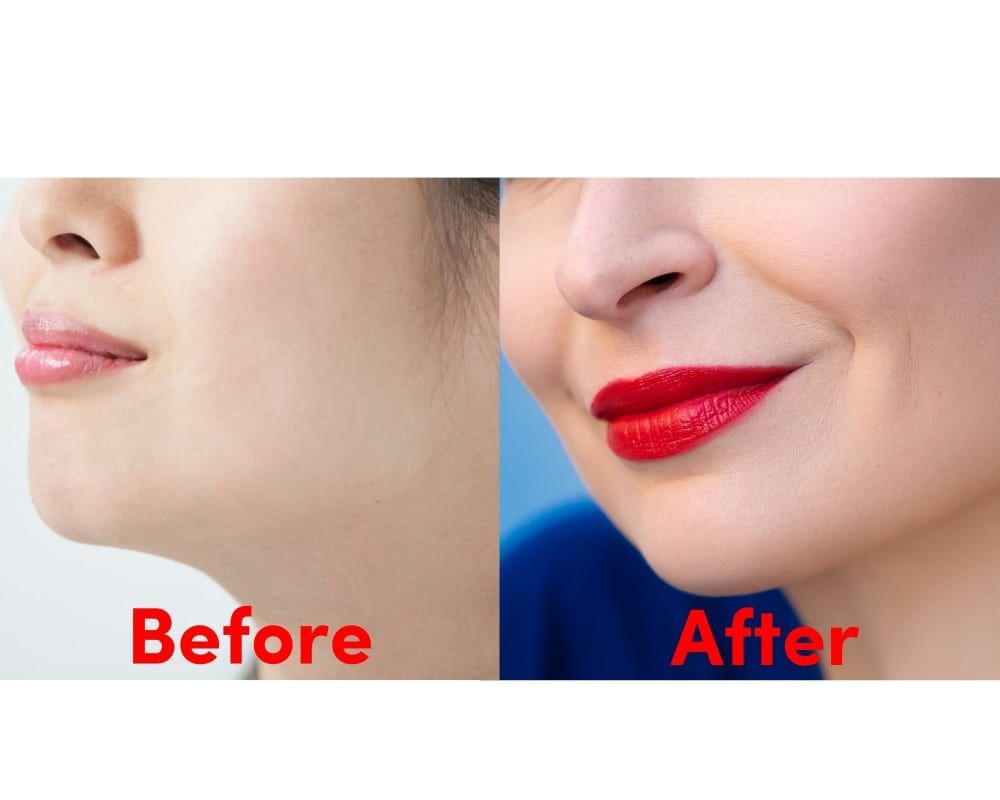 Surgery or mewing exercises. Result of a jawline reshape. Stock