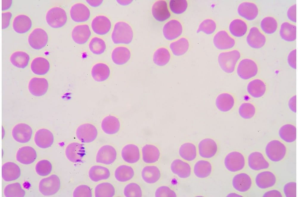 Anisocytosis: Causes, Diagnosis, Treatment & More