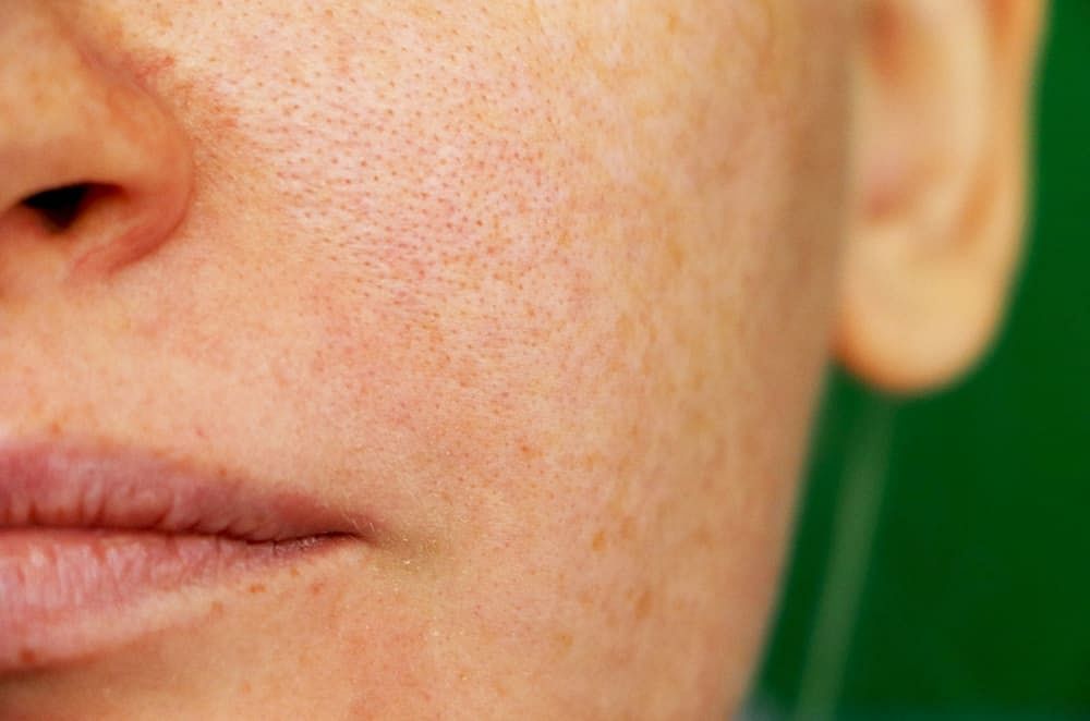 Open Pores Treatment at Home: 20 Ways You Can Treat Your Open Pores