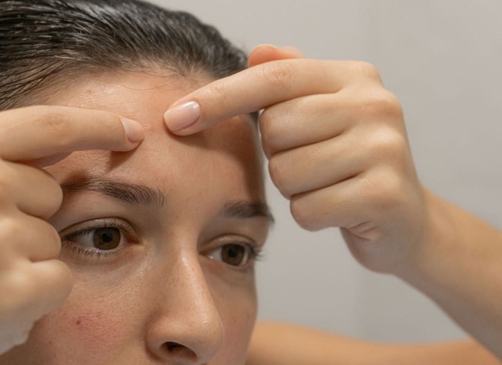 How to Get Rid of Forehead Pimples - Bodywise