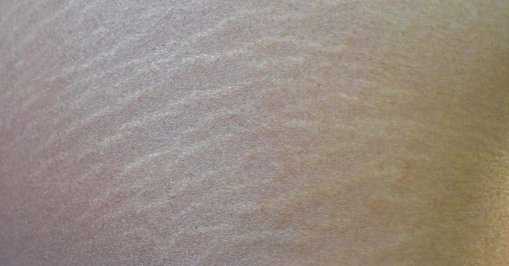 Stretch Marks on Breasts: Causes, Treatment, Prevention, More