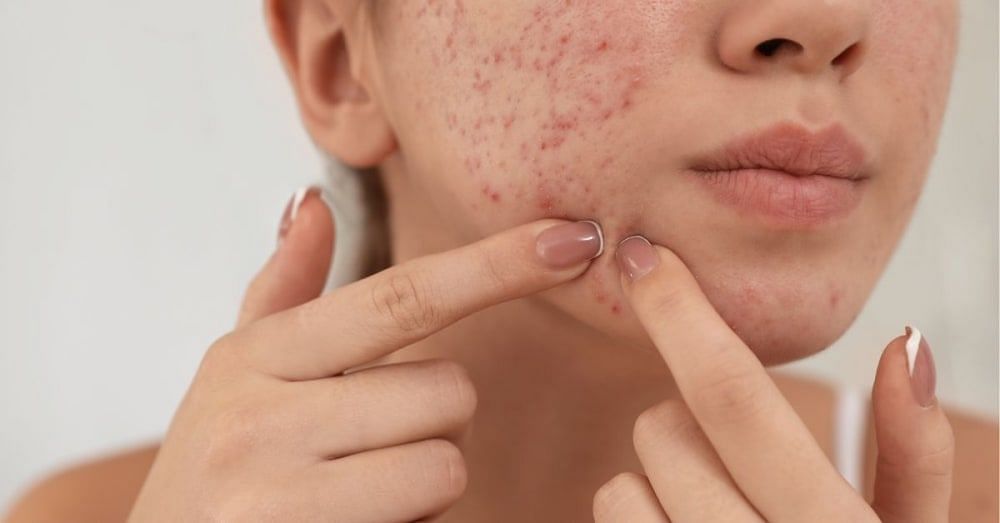 Blemishes On Face: Types, Causes & Home Remedies