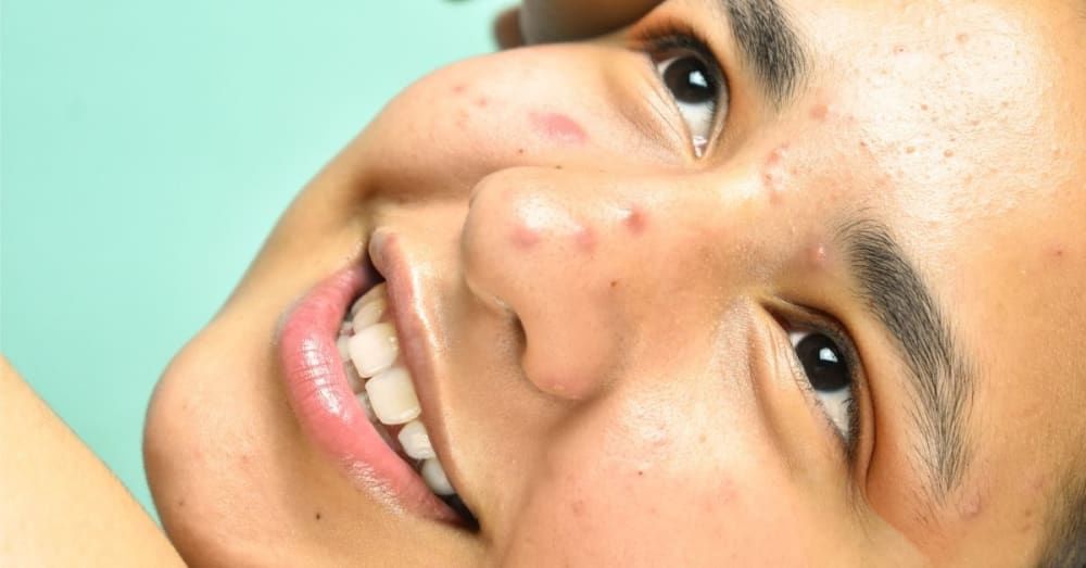 Black, pesky spots on the skin are often a beauty problem. They