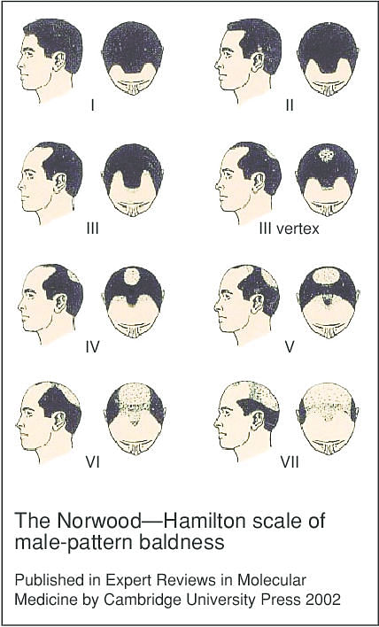 stages of male pattern balding on the norwood hamilton scale