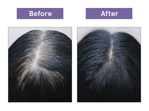 https://i.mscwlns.co/mosaic-wellness/image/upload/v1623501228/staging/products/Hair%20Growth%20Concentrate/Carousel%20NEW/before_after.jpg?tr=w-800