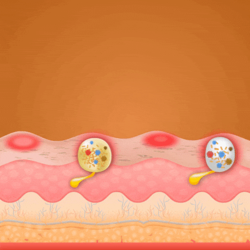 Reduces blemish production